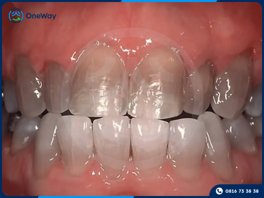 răng nhiễm tetracycline