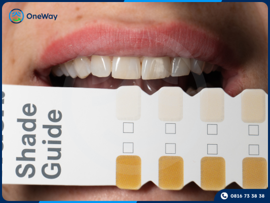 bọc răng sứ có tẩy trắng được không