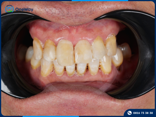 tẩy trắng răng ố vàng