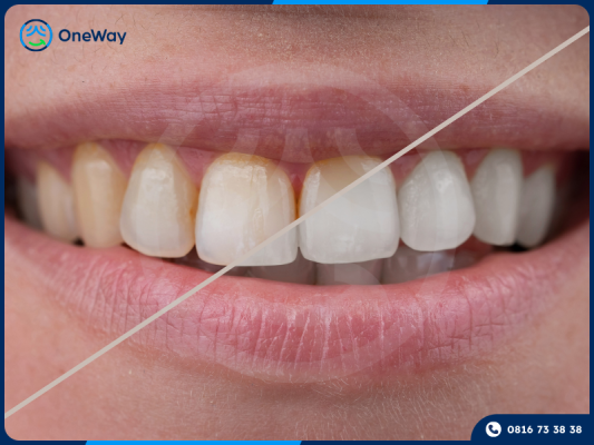 tẩy trắng răng có làm hư men răng không