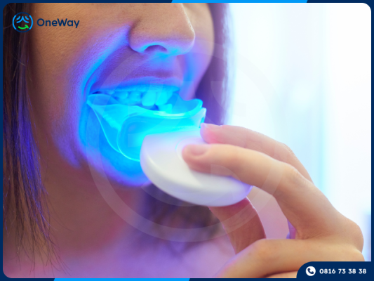 tẩy trắng răng tại nhà