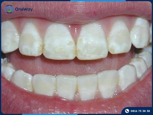 răng nhiễm fluor tẩy trắng răng có hiệu quả không