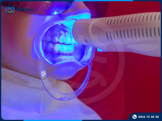 tẩy trắng răng tại nha khoa