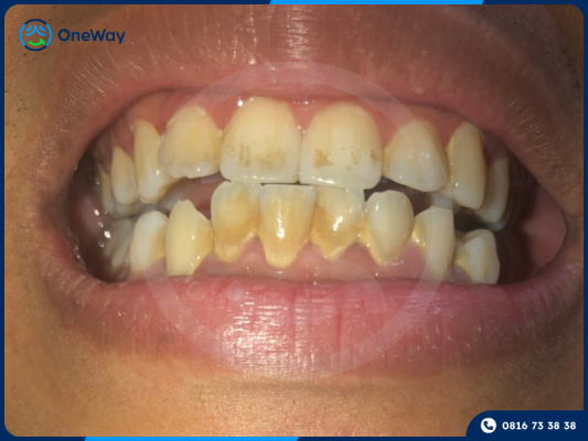 Răng ố vàng