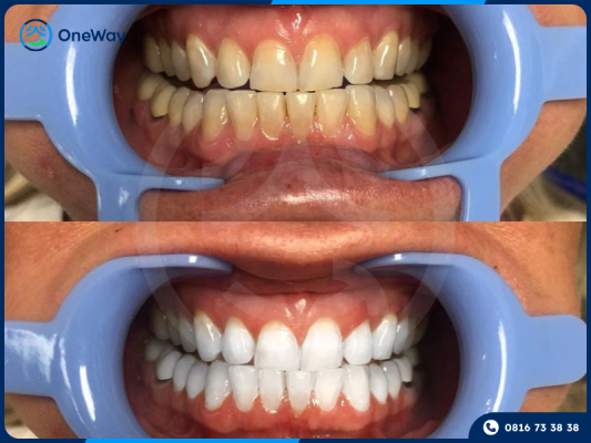 hiệu quả tẩy trắng răng