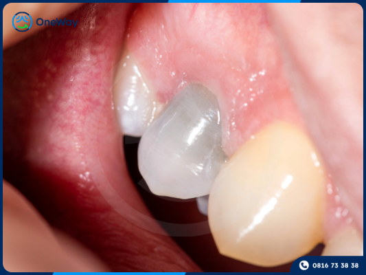 răng nhiễm tetracycline