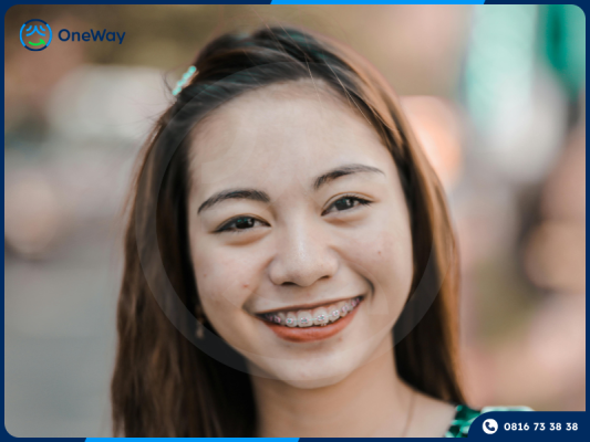 niềng răng mắc cài