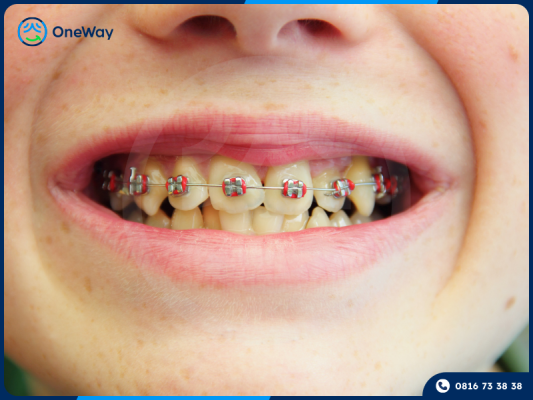 niềng răng mắc cài kim loại