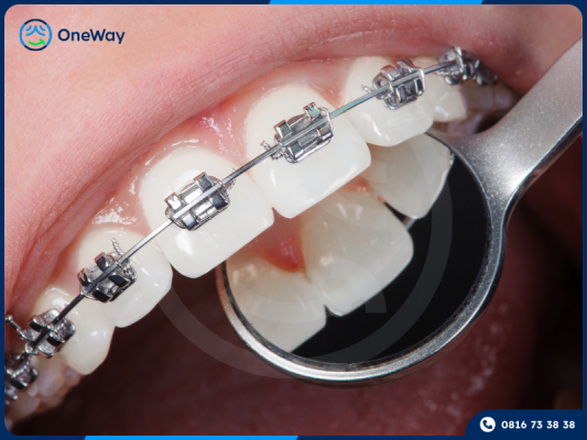 mắc cài kim loại thông minh