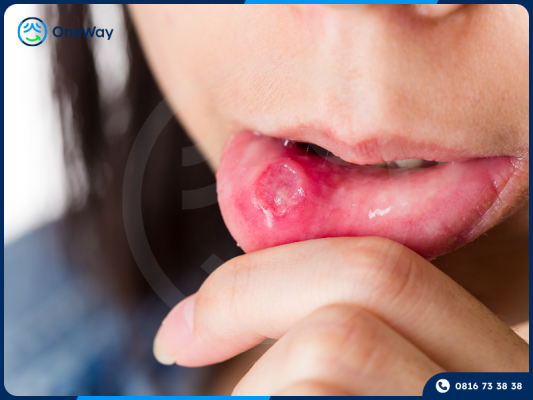 niềng răng mắc cài gây lở môi