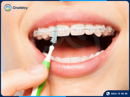 mắc cài sứ tự đóng