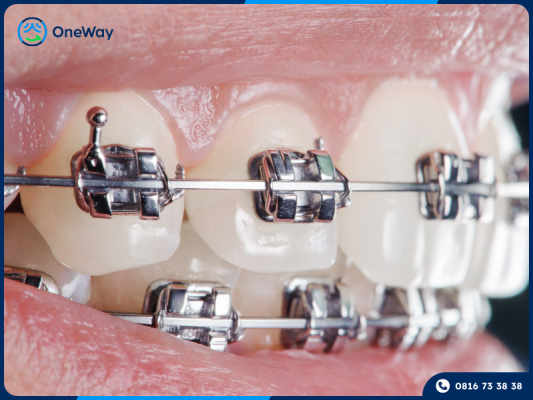 niềng răng mắc cài tự động