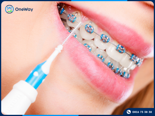 vệ sinh răng niềng