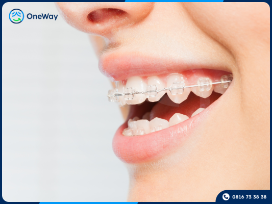 mắc cài pha lê tự buộc