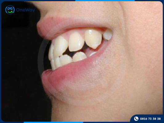 niềng răng hô tại nhà