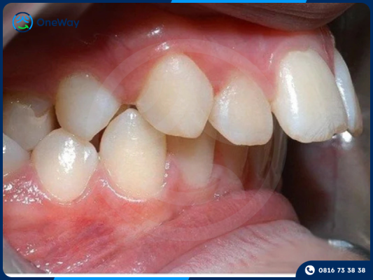 răng hô do di truyền