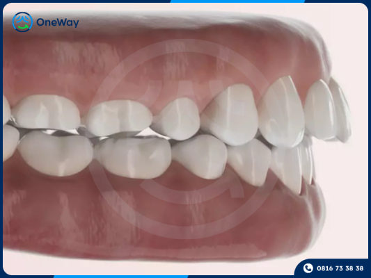 điều trị răng hô