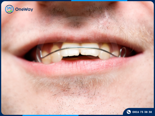 niềng răng tại nhà