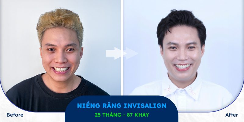 hiệu quả niềng răng khay trong suốt