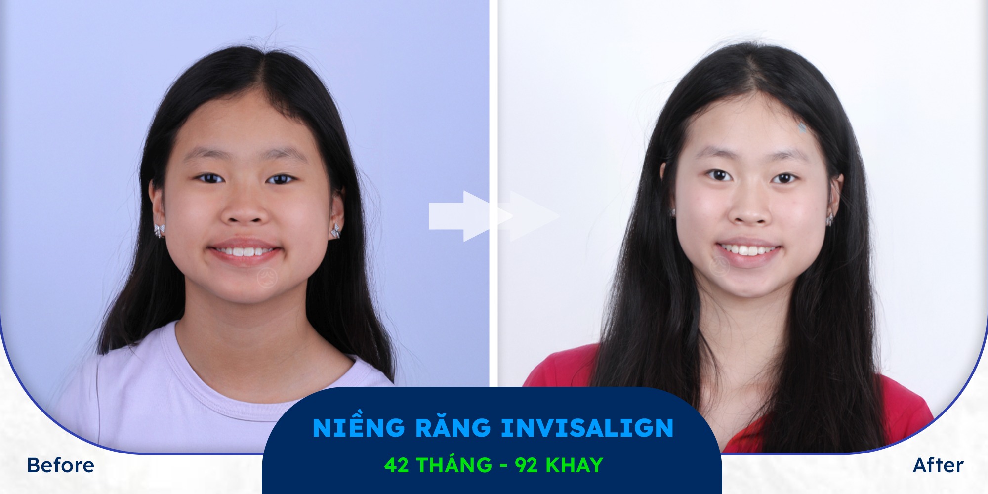 niềng răng hô bằng khay invisalign