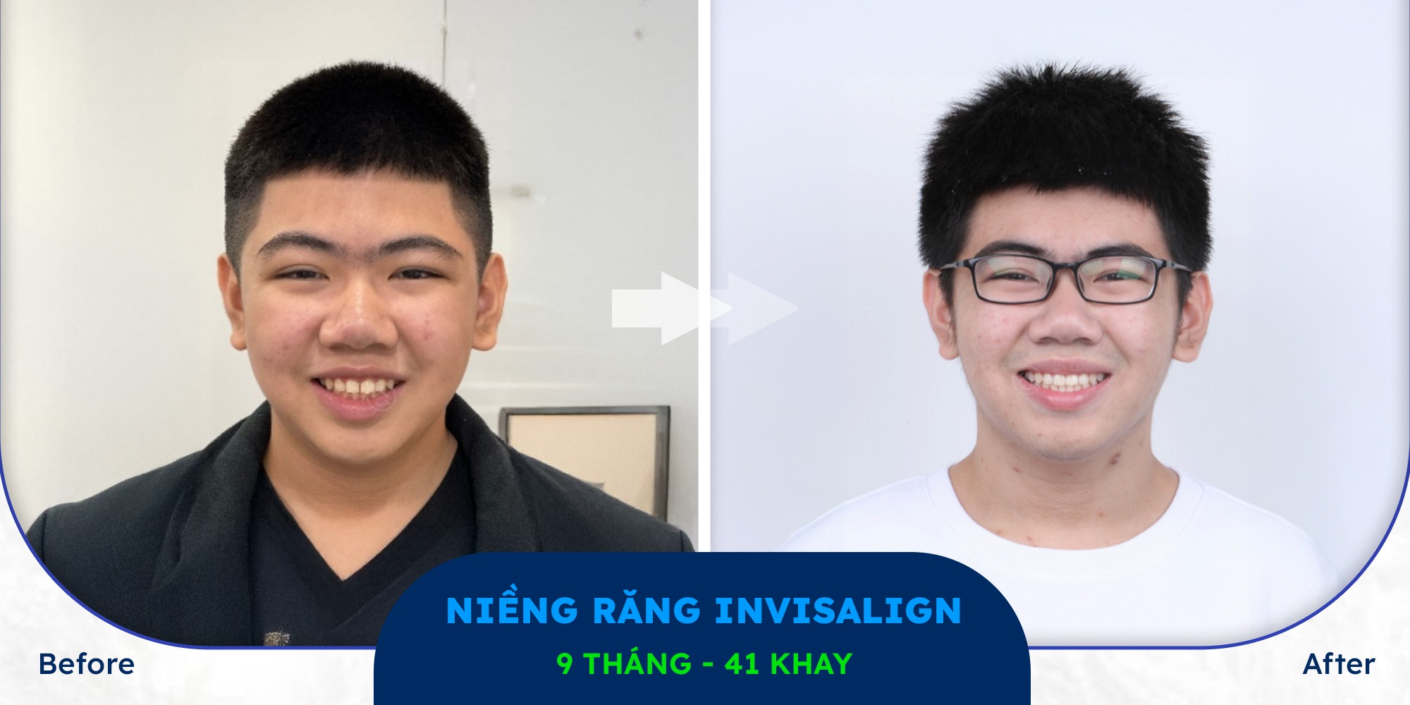 niềng răng khay trong suốt