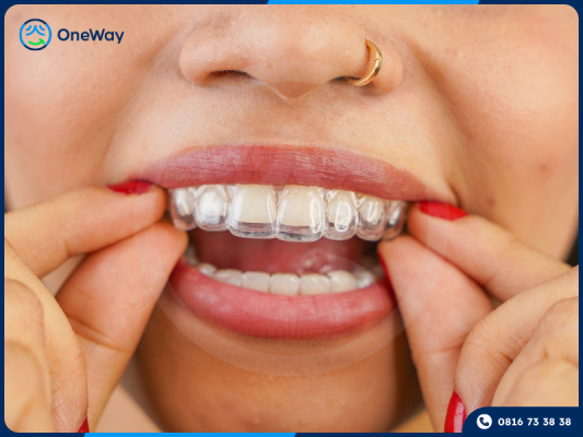 niềng răng trong suốt