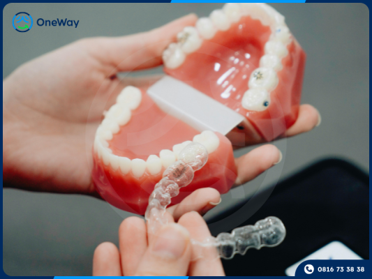 niềng răng khay trong suốt