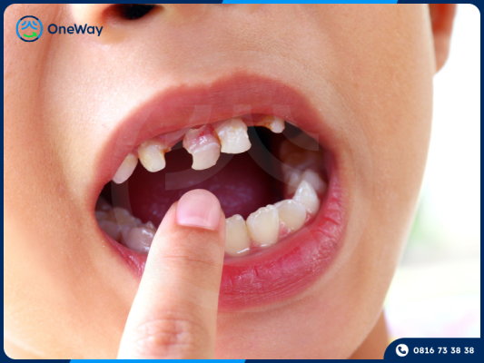 răng cửa bị lung lay