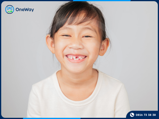 răng cửa bị thưa