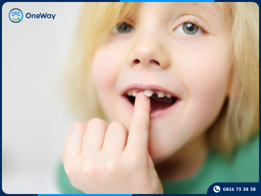 răng cửa lung lay