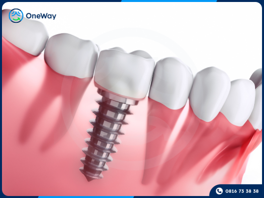 trồng răng Implant